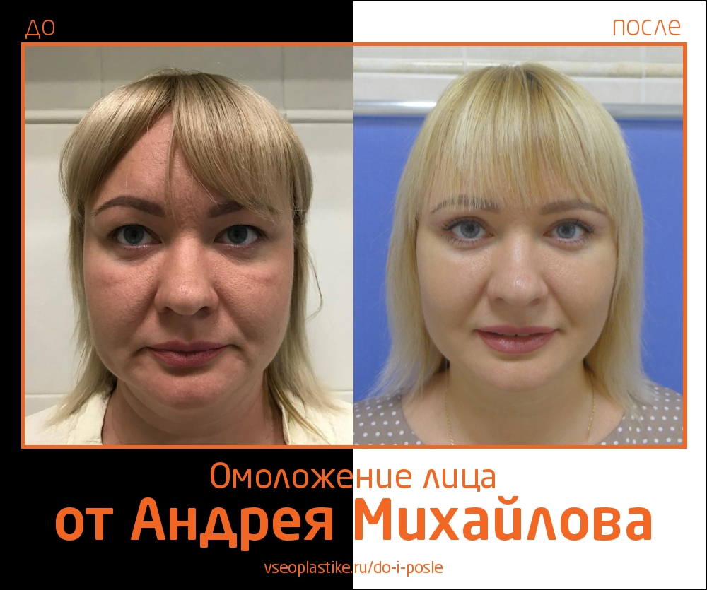 Пластический хирург Андрей Михайлов. Фото пациента до и после омоложения лица
