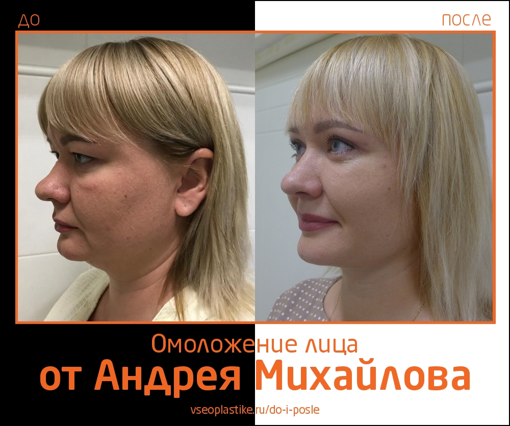Пациентка до и после омоложения лица у доктора Михайлова