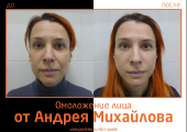 Андрей Михайлов. Фото пациентки до и после омоложения лица и шеи