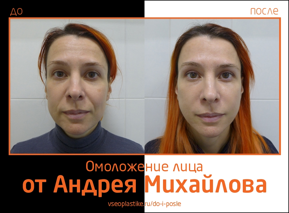 Андрей Михайлов. Фото пациентки до и после омоложения лица и шеи