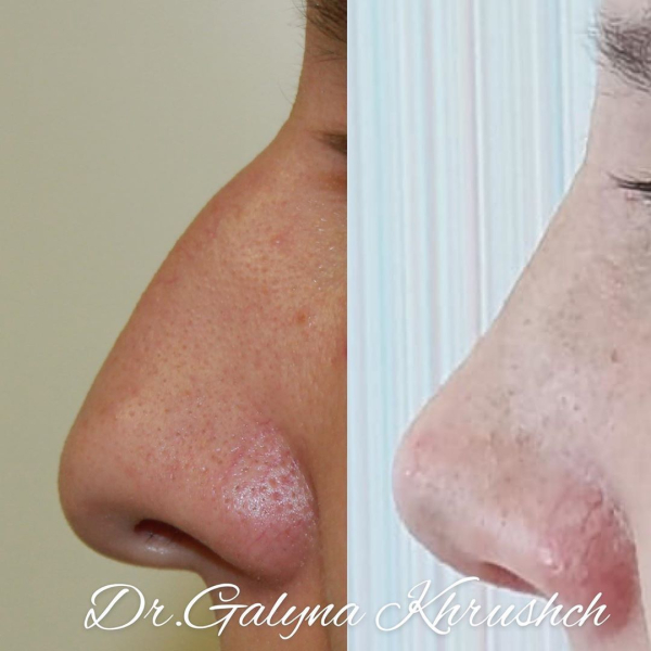 Фото до и после ринопластики у доктора Галины Хрущ