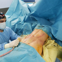 Пластический хирург Карен Пайтян проводит липомоделирование тела