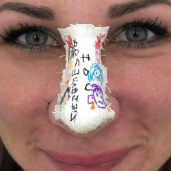 Нос после ринопластики гипс