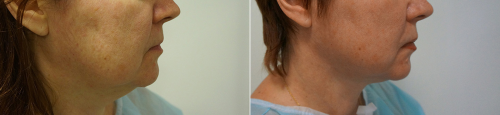 Подтяжка лица Арслан Пенаев