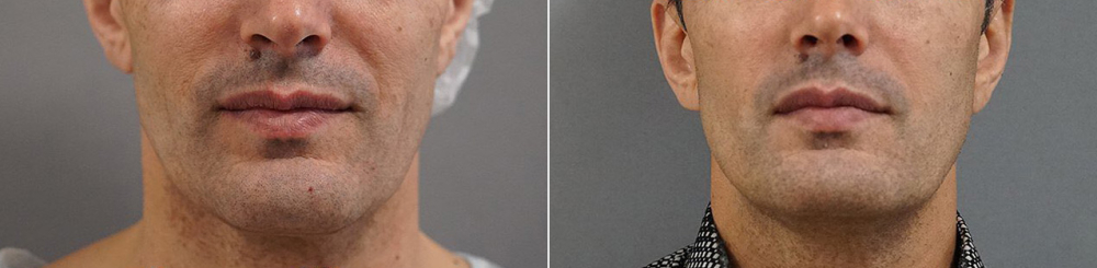 Пенаев подтяжка лица