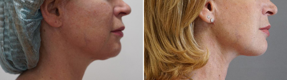 Арслан Пенаев подтяжка лица без операции