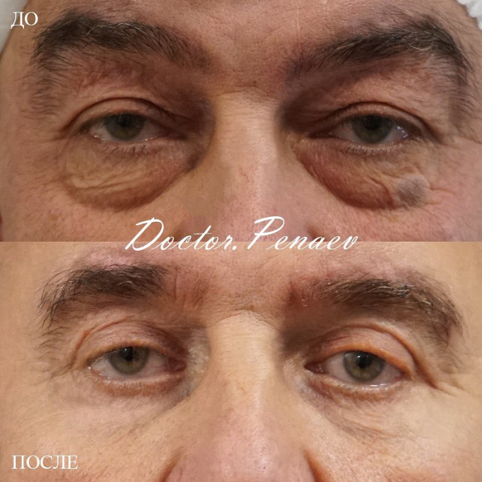 Пациент доктора Арслана Пенаева до и после круговой блефаропластики
