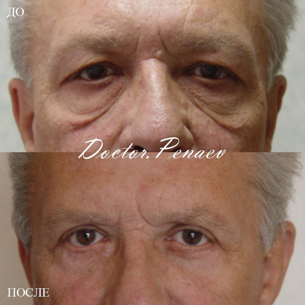 Пациент пластического хирурга Арслана Пенаева до и после мужской блефаропластики