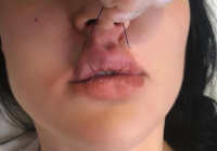 Пластику губ предлагают сделать при помощи нитей