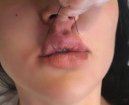 Пластику губ предлагают сделать при помощи нитей