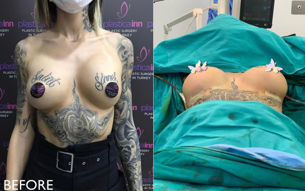 Марина Мексика снова сделала маммопластику