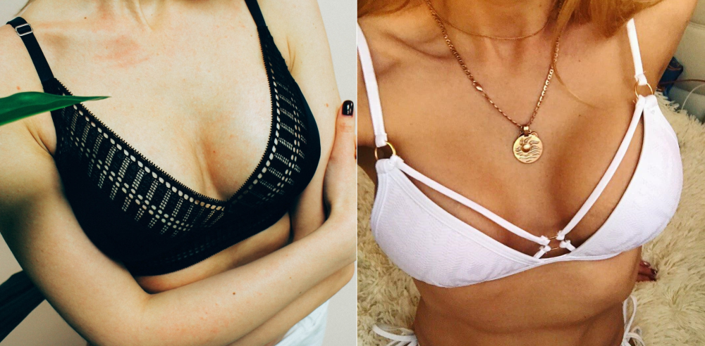 Пациентки доктора Станислава Екимова после маммопластики