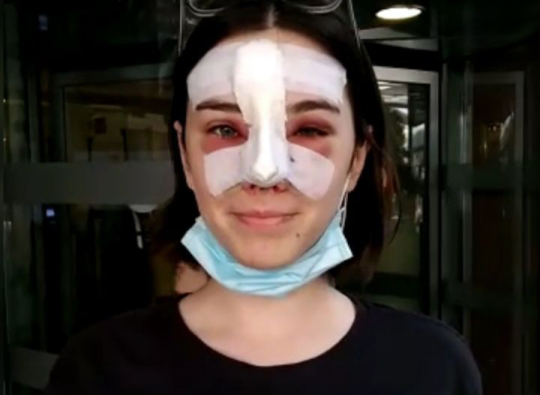 Гипс после ринопластики