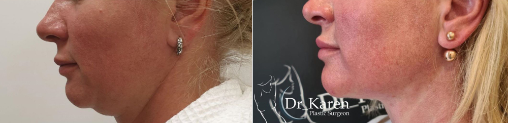 липомоделирование подбородка Карен Пайтян