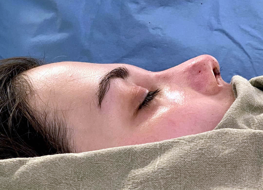 третий день после ринопластики