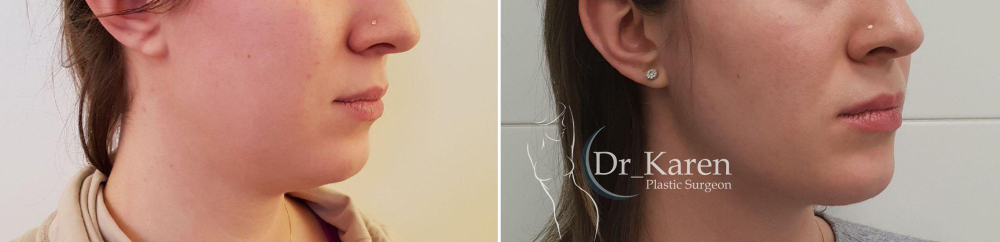 липомоделирование подбородка