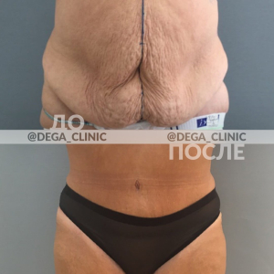 абдоминопластика Марина Четверикова