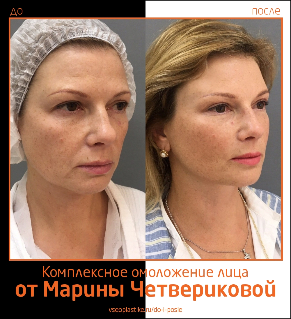 Марина Четверикова подтяжка лица