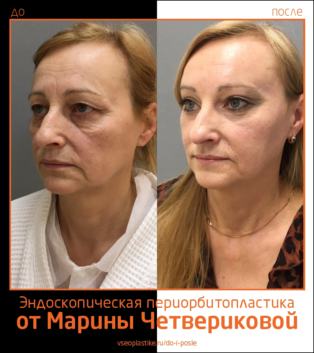 Марина Четверикова. Фото до и после эндоскопической периорбитопластики