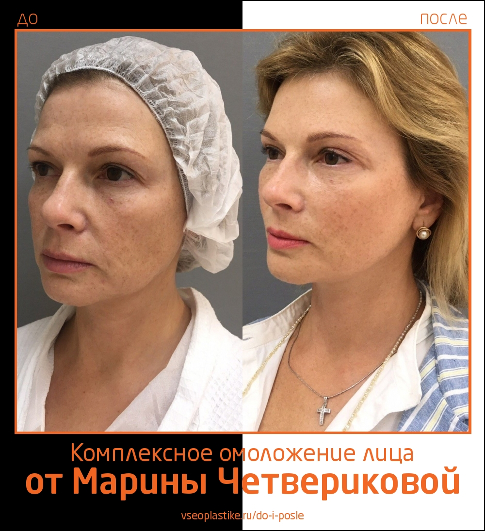 Марина Четверикова подтяжка лица