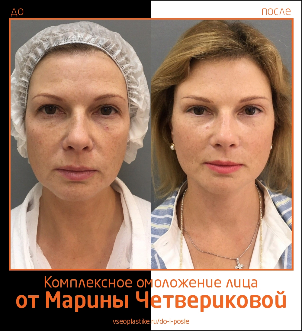 Марина Четверикова подтяжка лица