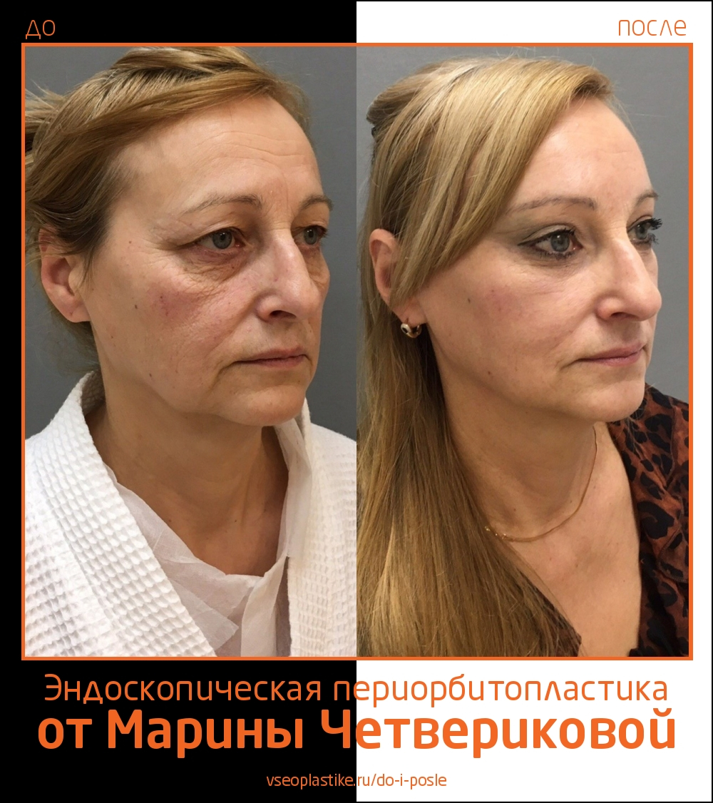 Марина Четверикова. Фото до и после эндоскопической периорбитопластики