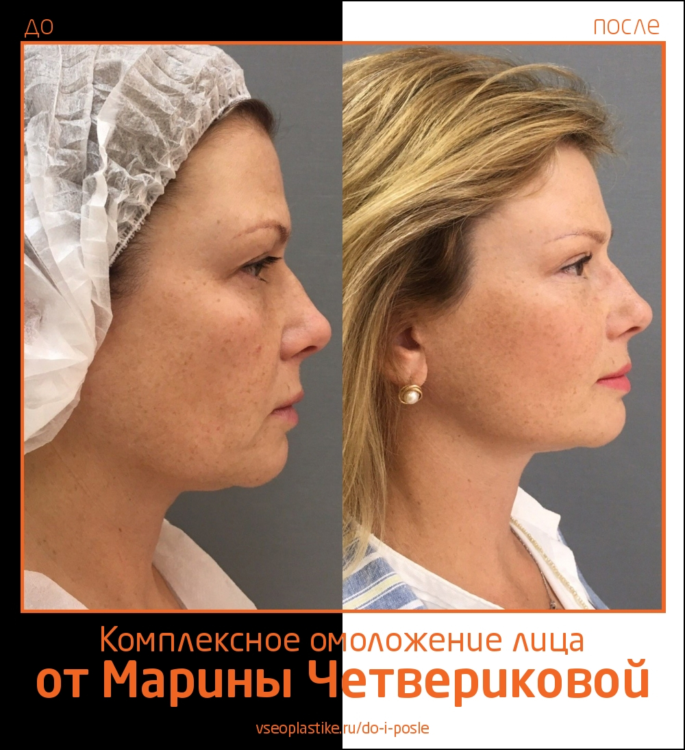 Марина Четверикова подтяжка лица