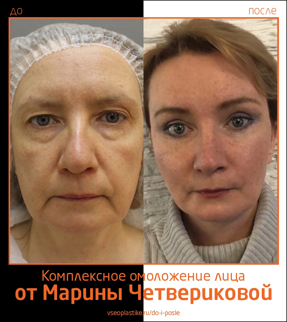 Эндоскопия верхней и средней зоны с перераспределением жировых пакетов с средней зоне, верхняя и нижняя блефаропластика, СМАС-подтяжка нижней трети лица, передняя платизмопластика.