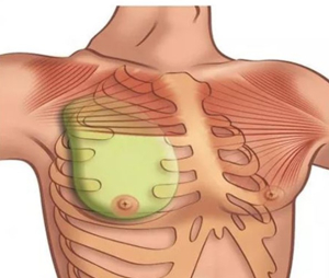 3D-моделирование импланта для реконструкции груди при синдроме Поланда