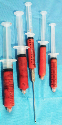 Сколько продлится эффект от пересадки жира?