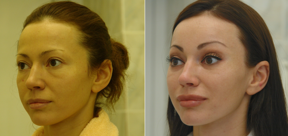 Пациентка Эстет Клиники до и после подтяжки лица