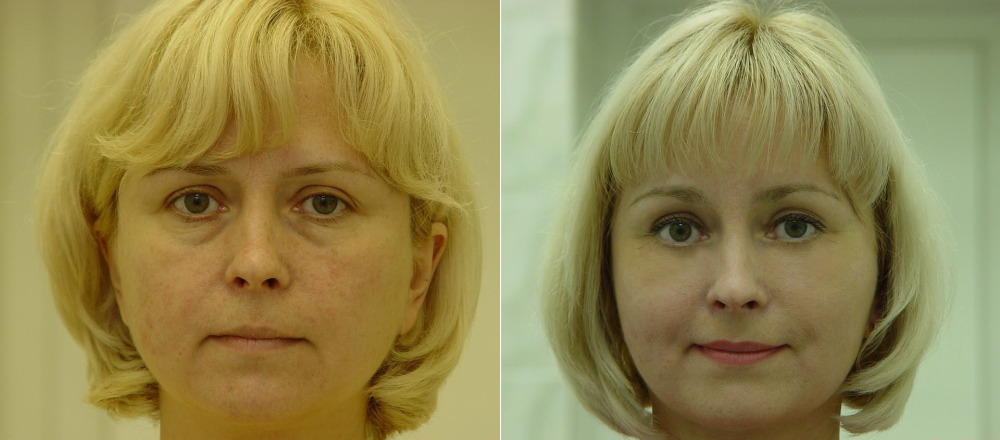 Фото пациентки Эстет Клиники до и после подтяжки лица