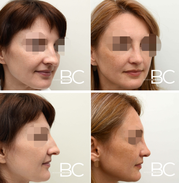 Пациентка доктора Стайсупова до и после ринопластики