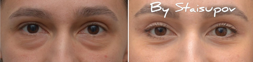 Пациентка пластического хирурга Валерия Стайсупова до и после пластики нижних век