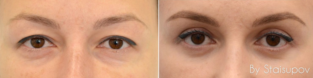 Пациентка пластического хирурга Валерия Стайсупова до и после подтяжки верхних век