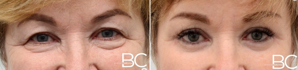 Пациентка доктора Стайсупова до и после периорбитопластики