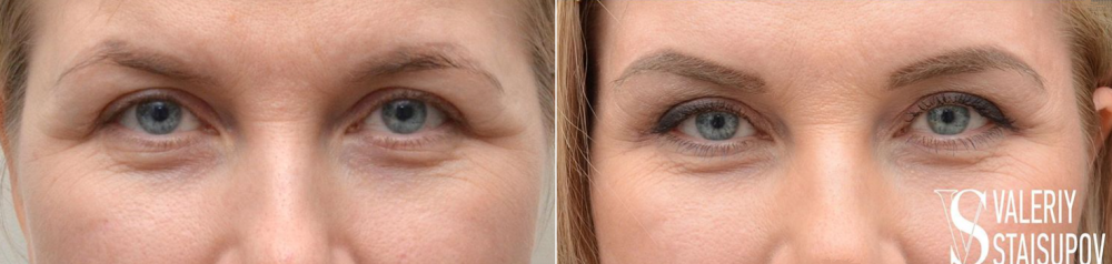 Пациентка доктора Валерия Стайсупова до и после верхней блефаропластики