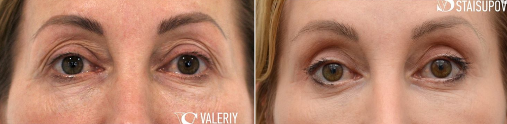 Пациентка пластического хирурга Валерия Стайсупова до и после периорбитопластики