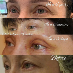 Пациентка доктора Галины Хрущ до и после блефаропластики