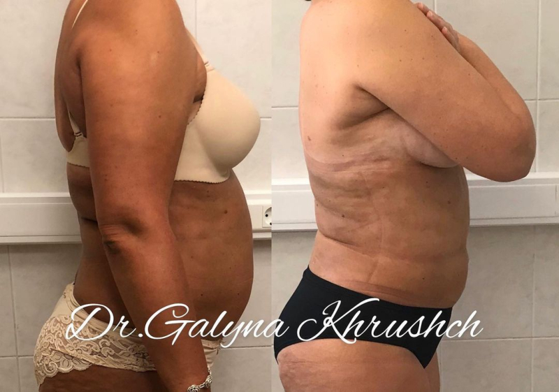 Фото пациентки до и после липосакции у пластического хирурга Галины Хрущ