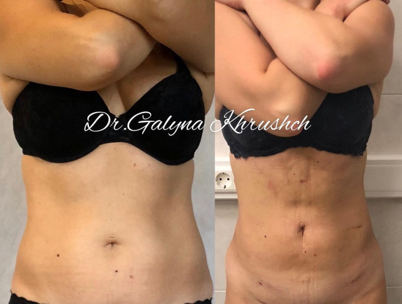 Фото до и после липосакции живота и боков у пластического хирурга Галины Хрущ