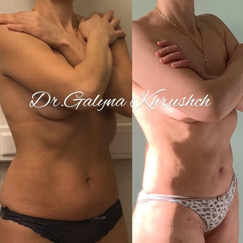 Фото до и после липосакции у пластического хирурга Галины Хрущ