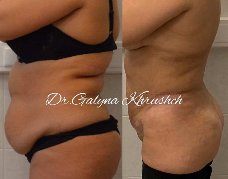 Снимок до и после липосакции у доктора Галины Хрущ