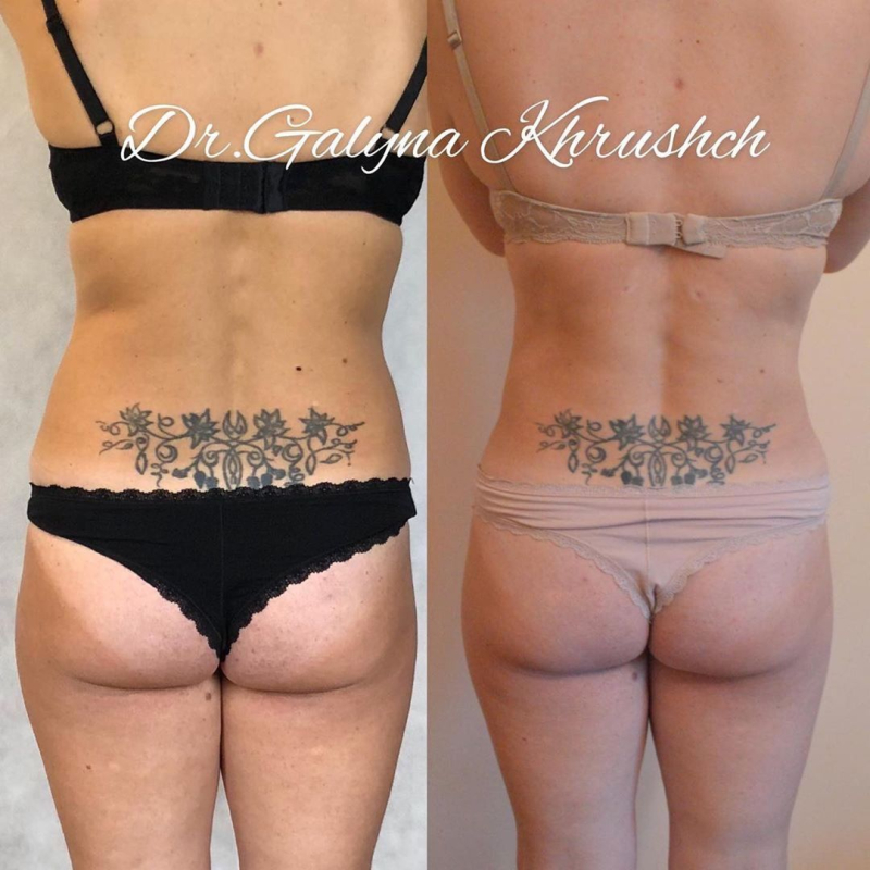 Пациентка до и после липосакции у доктора Галины Хрущ