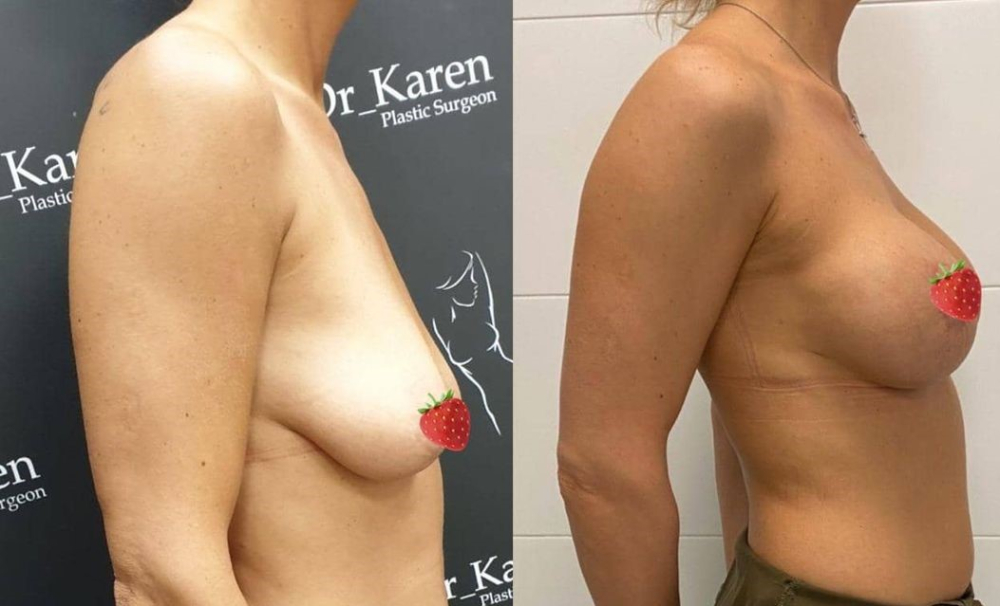 Пациентка доктора Карена Пайтяна до и после маммопластики