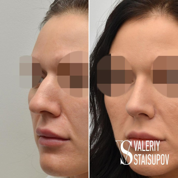Пациентка доктора Валерия Стайсупова до и после ринопластики.