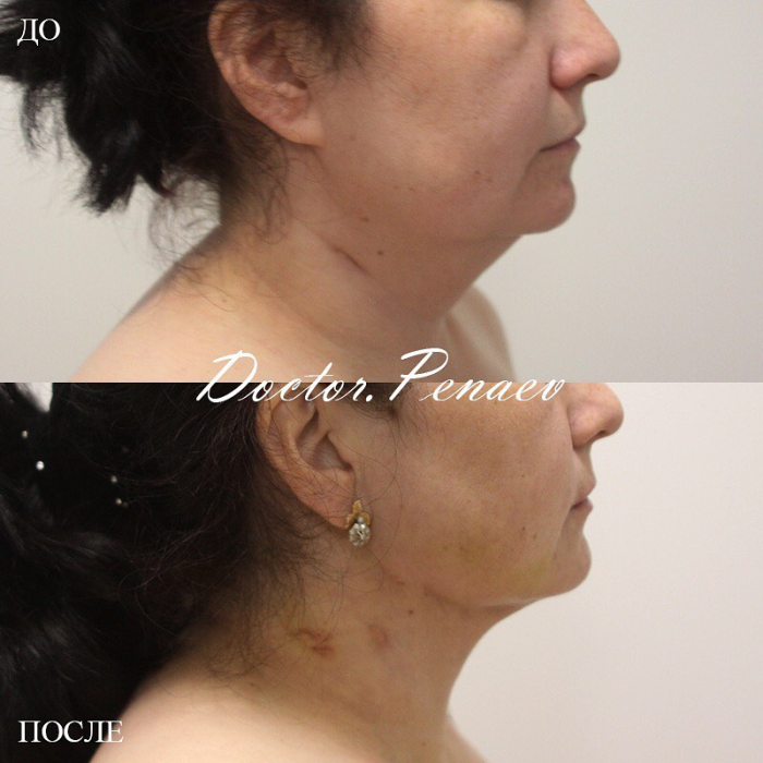 Пациентка до и после VASER-липомоделирования подбородочной области и шеи