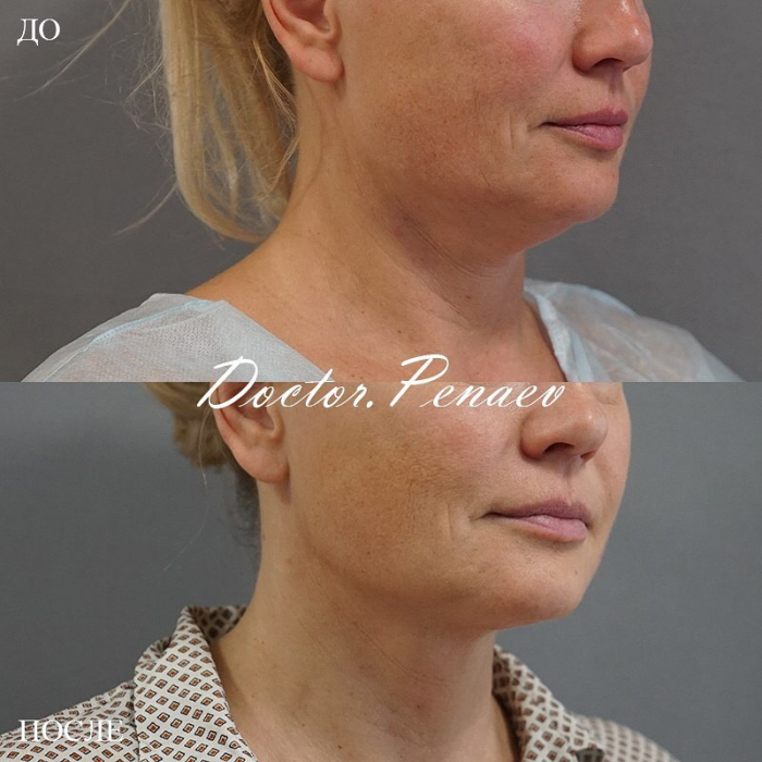 Пациентка до и после омоложения лица и шеи у доктора Арслана Пенаева