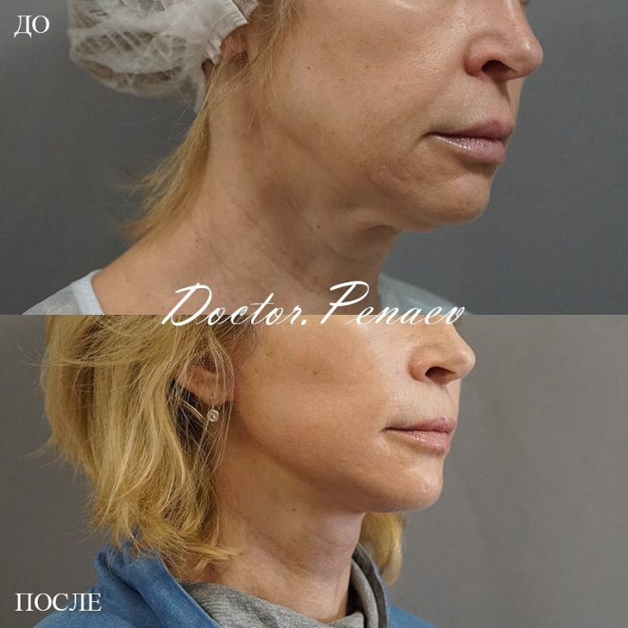 Пациентка до и после SMAS-подтяжки и ультразвуковой диссекцией тканей лица