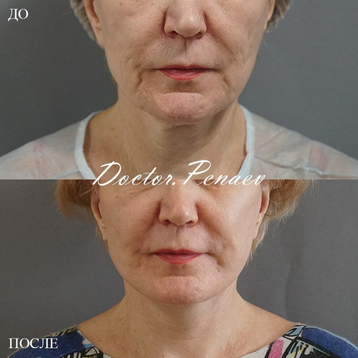 Фото пациентки до и после SMAS-подтяжки и ультразвуковой диссекцией тканей лица